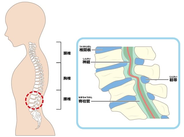 脊柱管狭窄症のイメージ